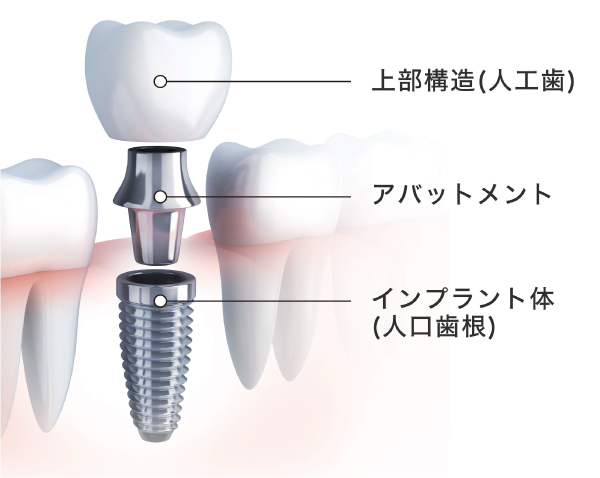 インプラントの構造（上部構造・アバットメント・インプラント体）